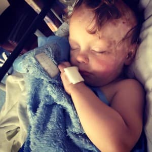 Ephraim van Dijk, just 8 months old at the time of the fire, has faced more than a year of medical procedures to heal his scalp and regrow hair. (Courtesy van Dijk family)